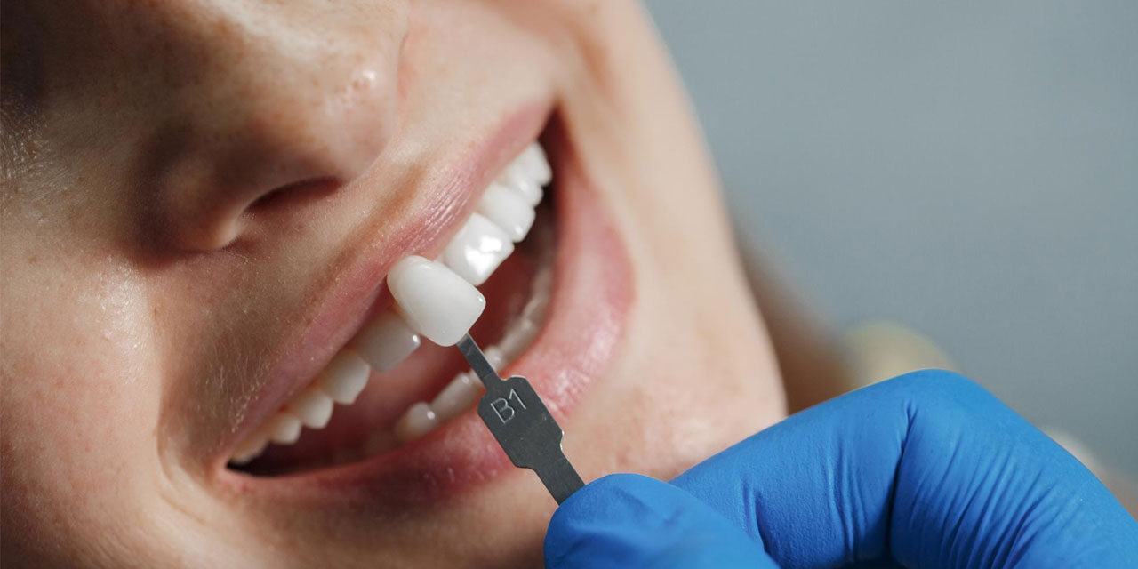 Dental Crowns