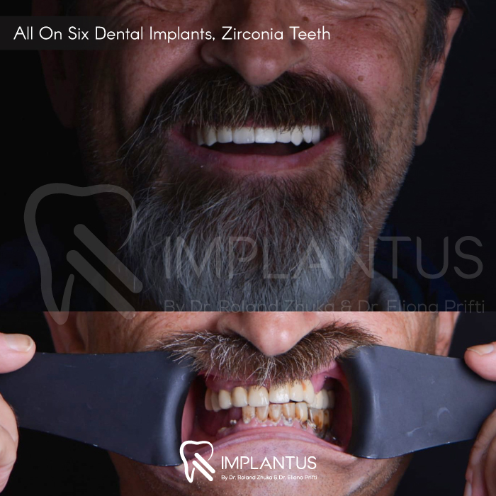 allonsix-dental-implants-zirconia-teeth-1