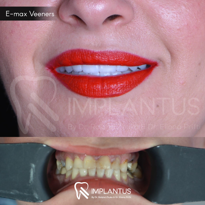 emax-veeners-2