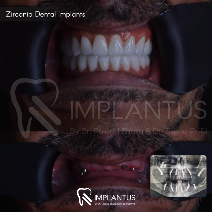 zirconia-dental-implants