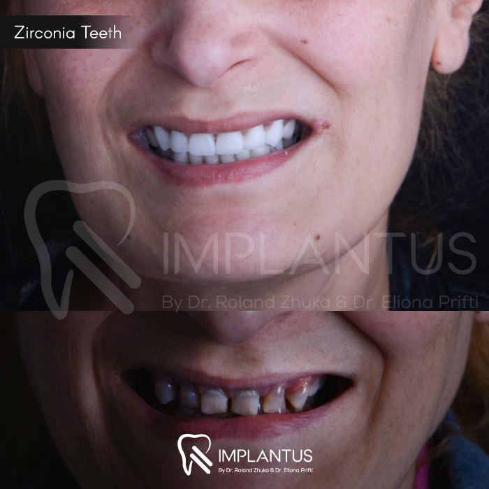 zirconia-teeth-4