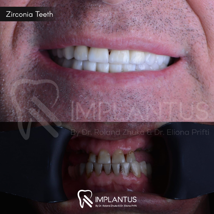 zirconia-teeth-9