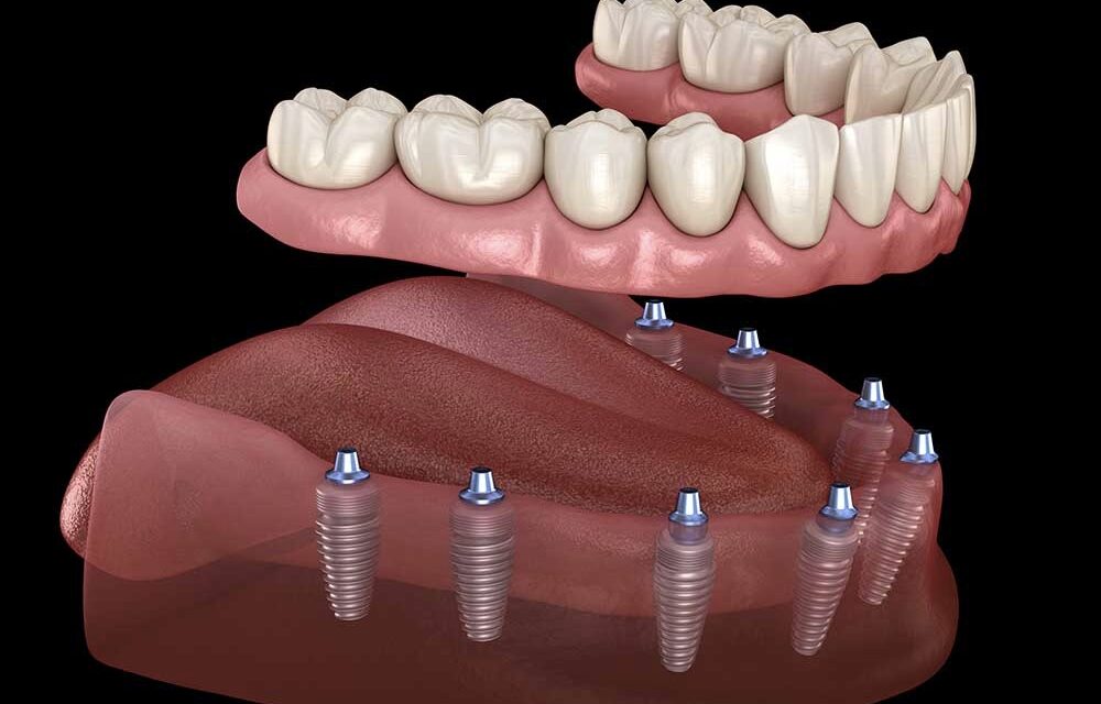 Considerazioni Quando si Sceglie la Migliore Clinica Dentale in Albania Per Gli Impianti Dentali