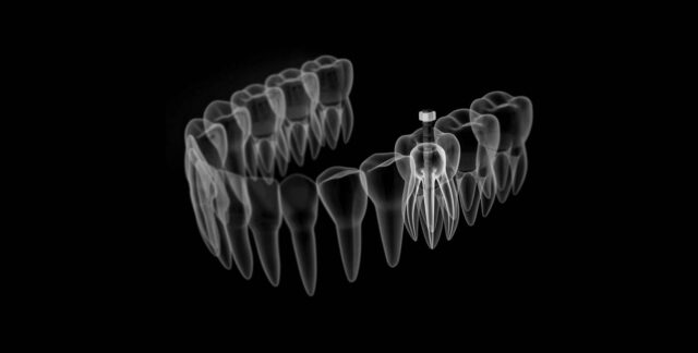 best clinic in albania - dental implant