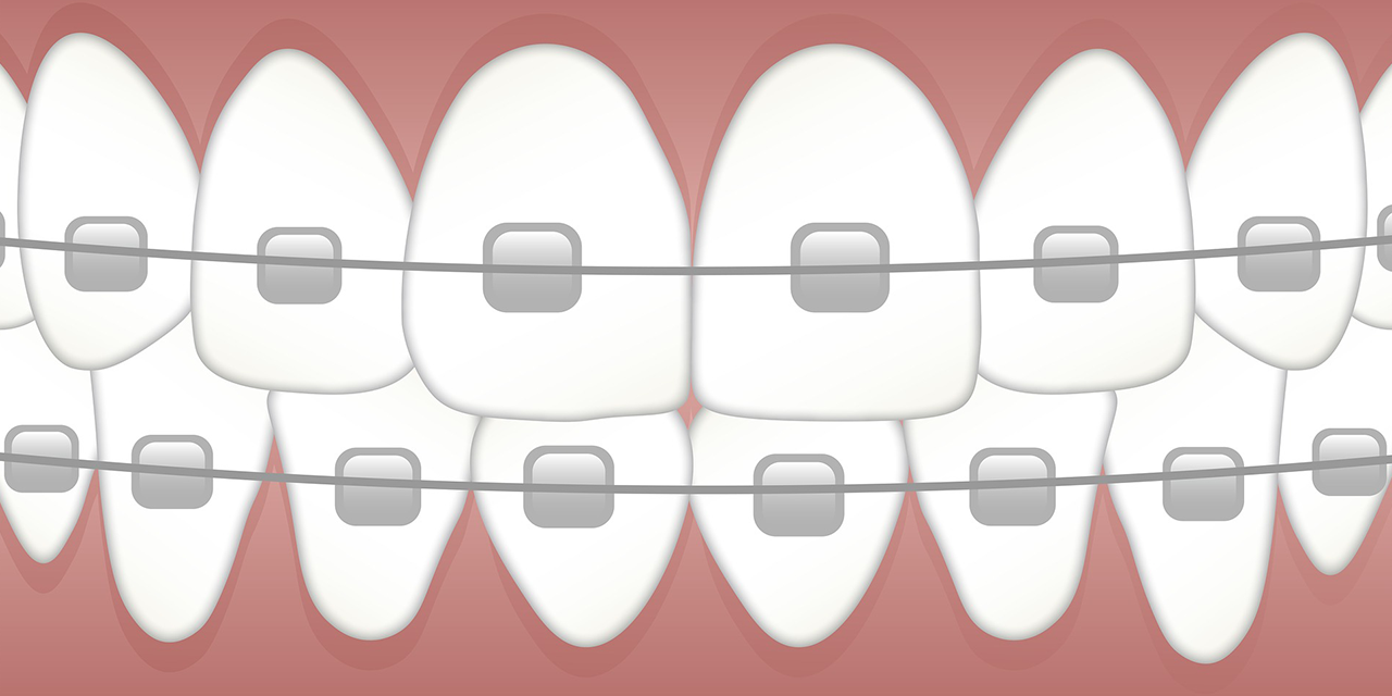 Esplorare il Processo di Ottenimento di Parentesi Graffe Tradizionali e Invisalign