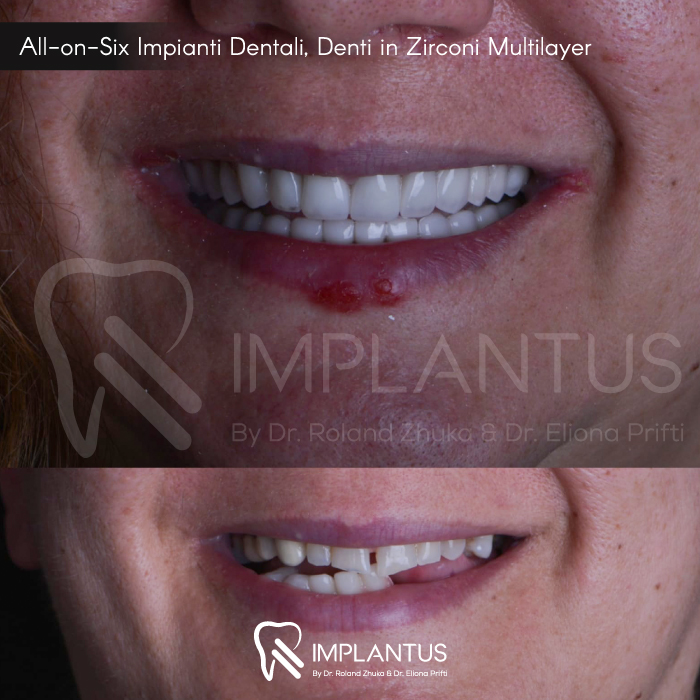 All-on-Six-Impianti-Dentali,-Denti-in-Zirconi-Multilayer--3