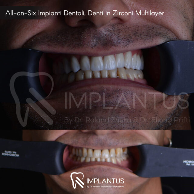 Impianti Dentali Albania Recensioni