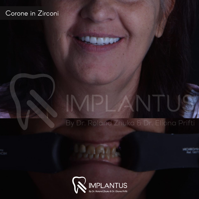 Corone-in-Zirconi