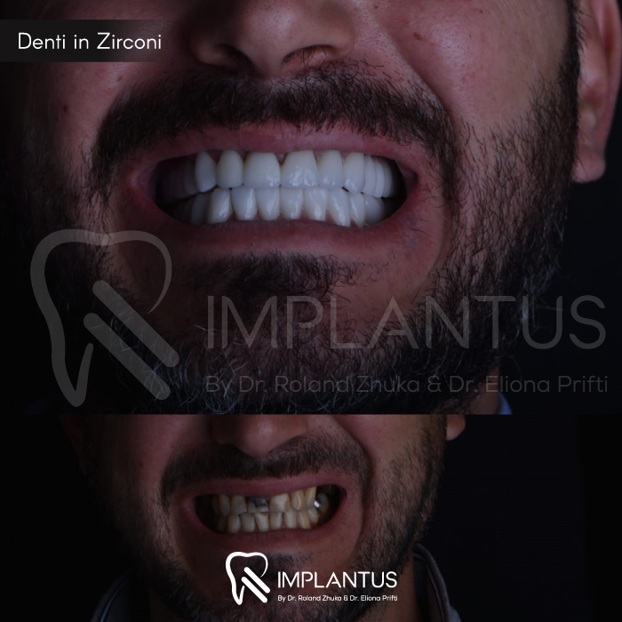 Denti-in-Zirconi--1