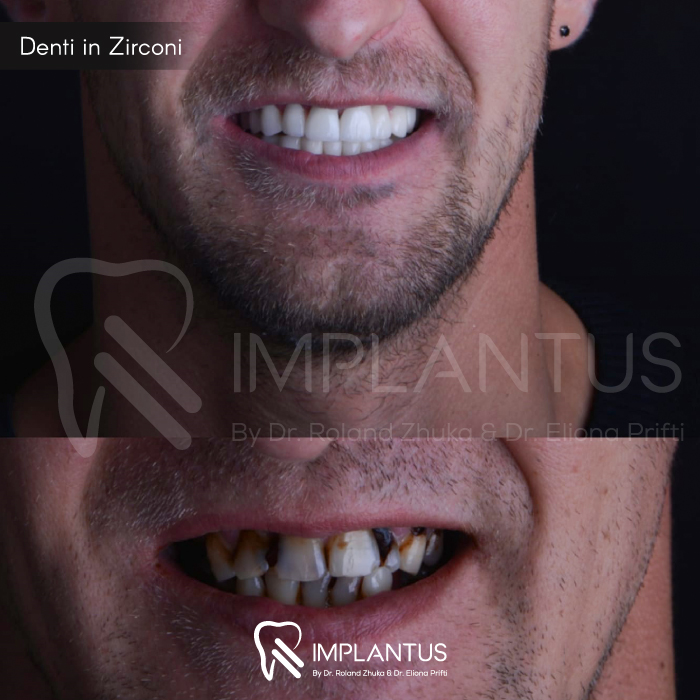 Denti-in-Zirconi--10