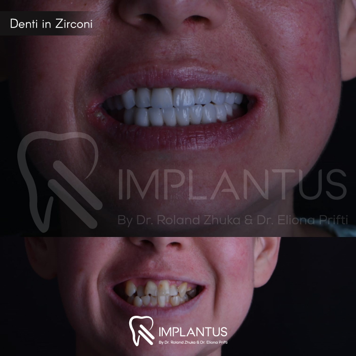 Denti-in-Zirconi--3