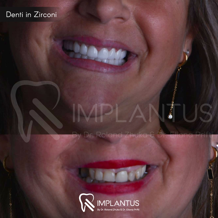 Denti-in-Zirconi--7