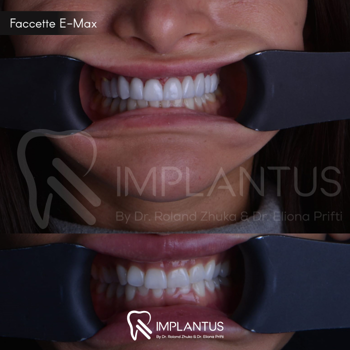 Faccette-E-Max