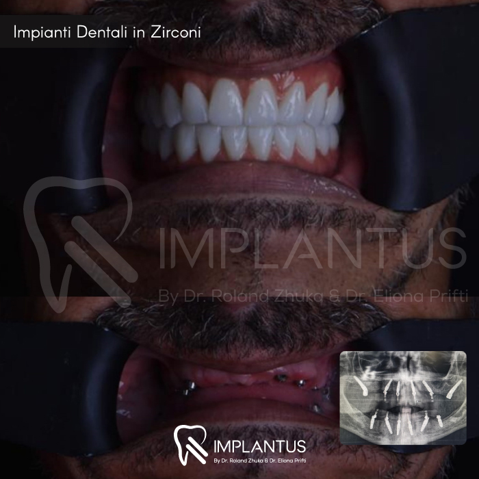 Impianti-Dentali-in-Zirconi