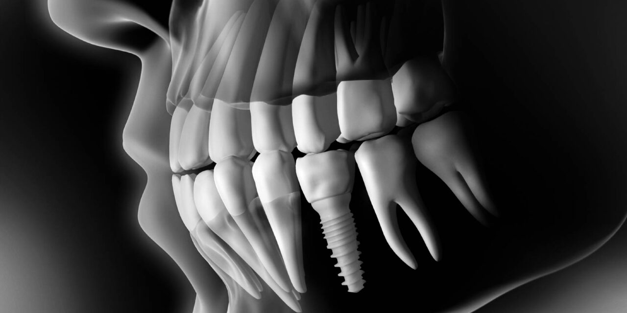 Una guida per trovare il tipo di impianto dentale giusto per te