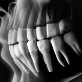 dental implants