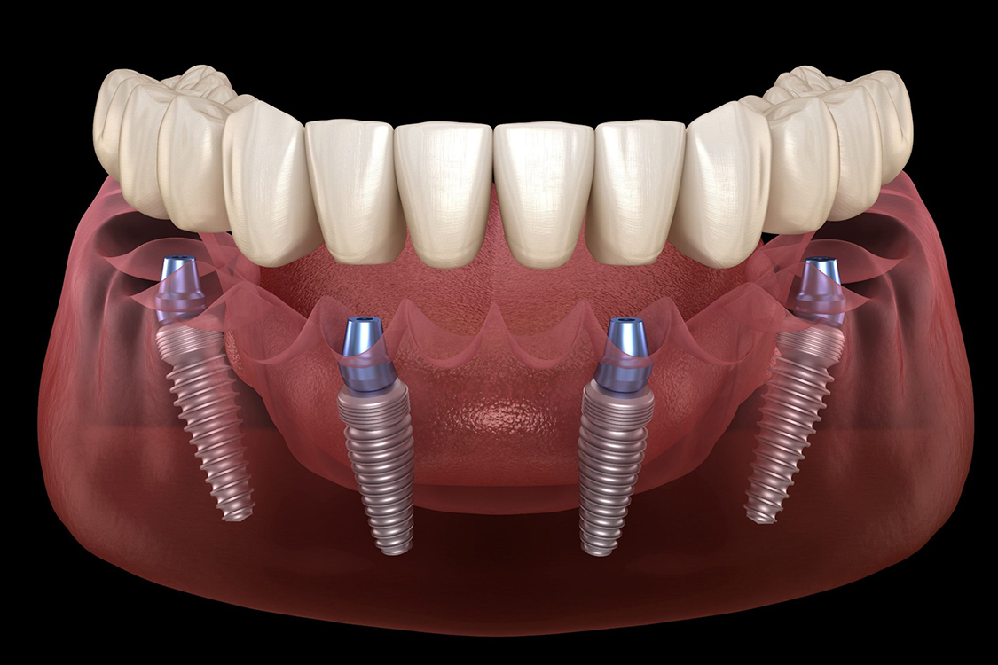 all-on-4-dental-implants