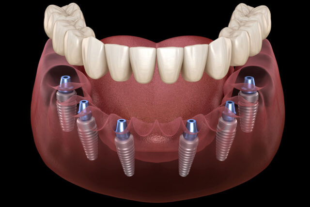 impianti dentali in Albania