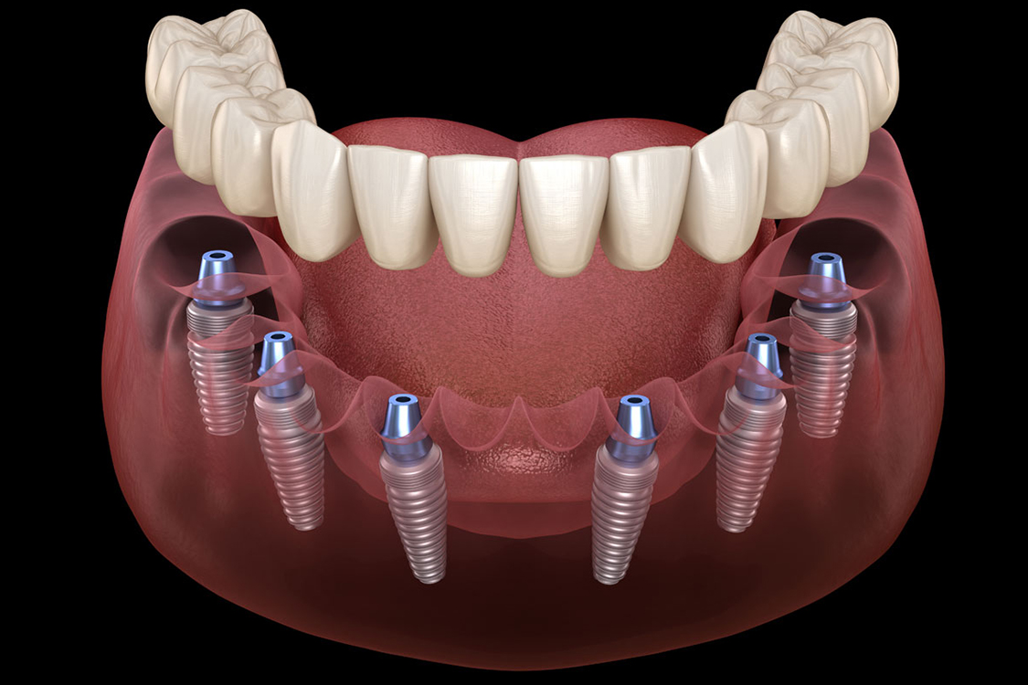 all-on-6-dental-implants