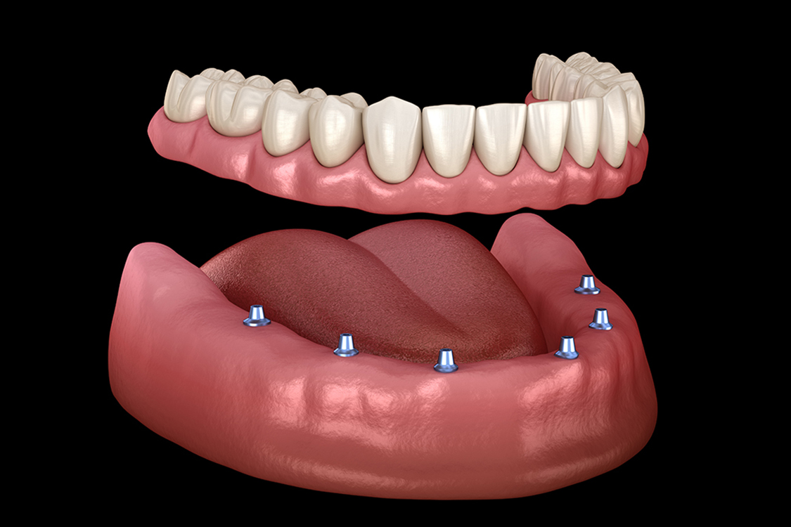 all-on-8-dental-implants