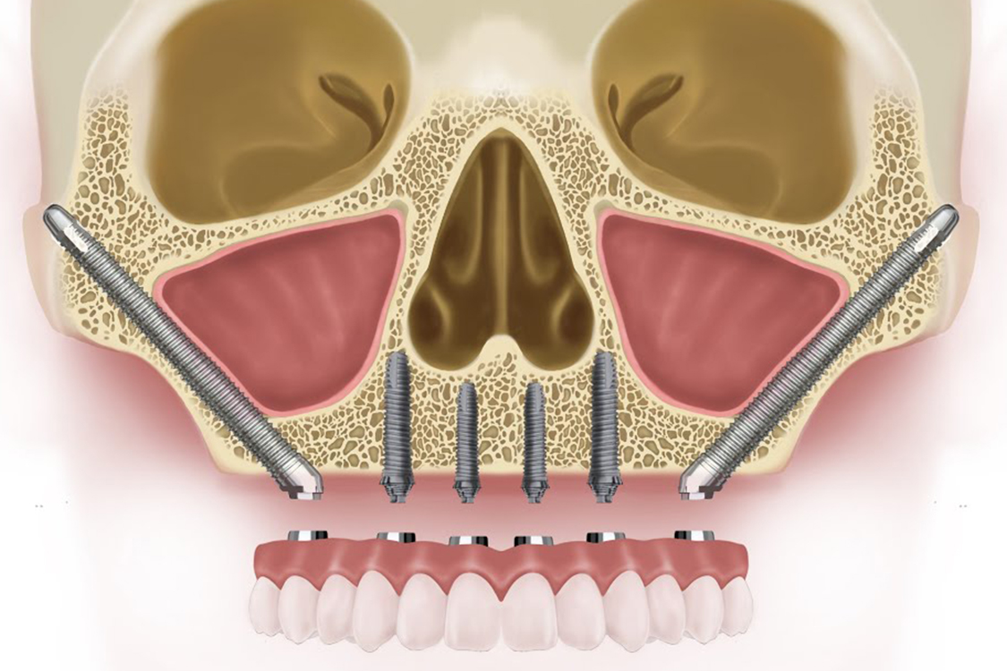 pterigoid